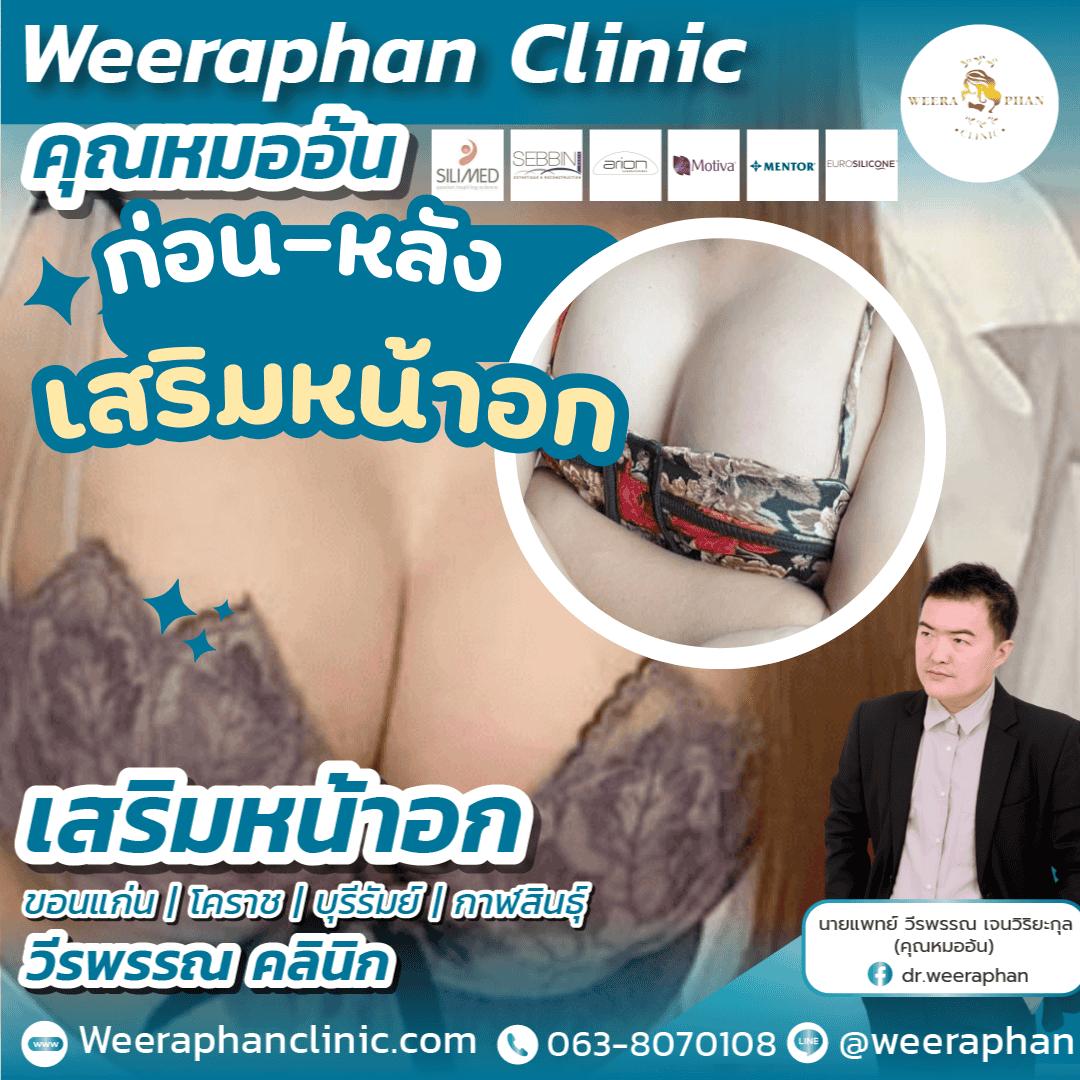 เสริมหน้าอก ศรีสะเกษ
