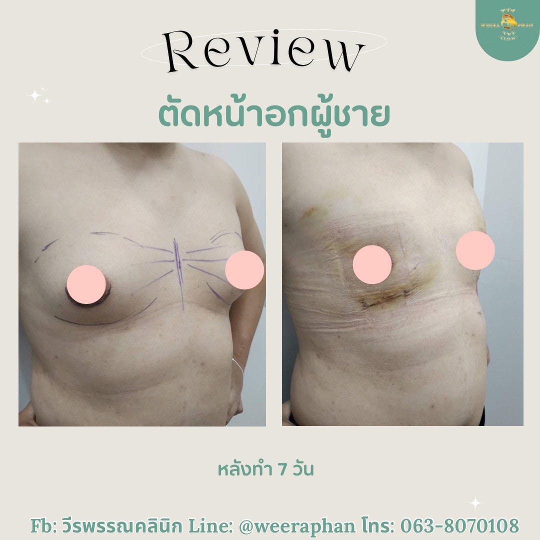 ตัดหน้าอกผู้ชาย