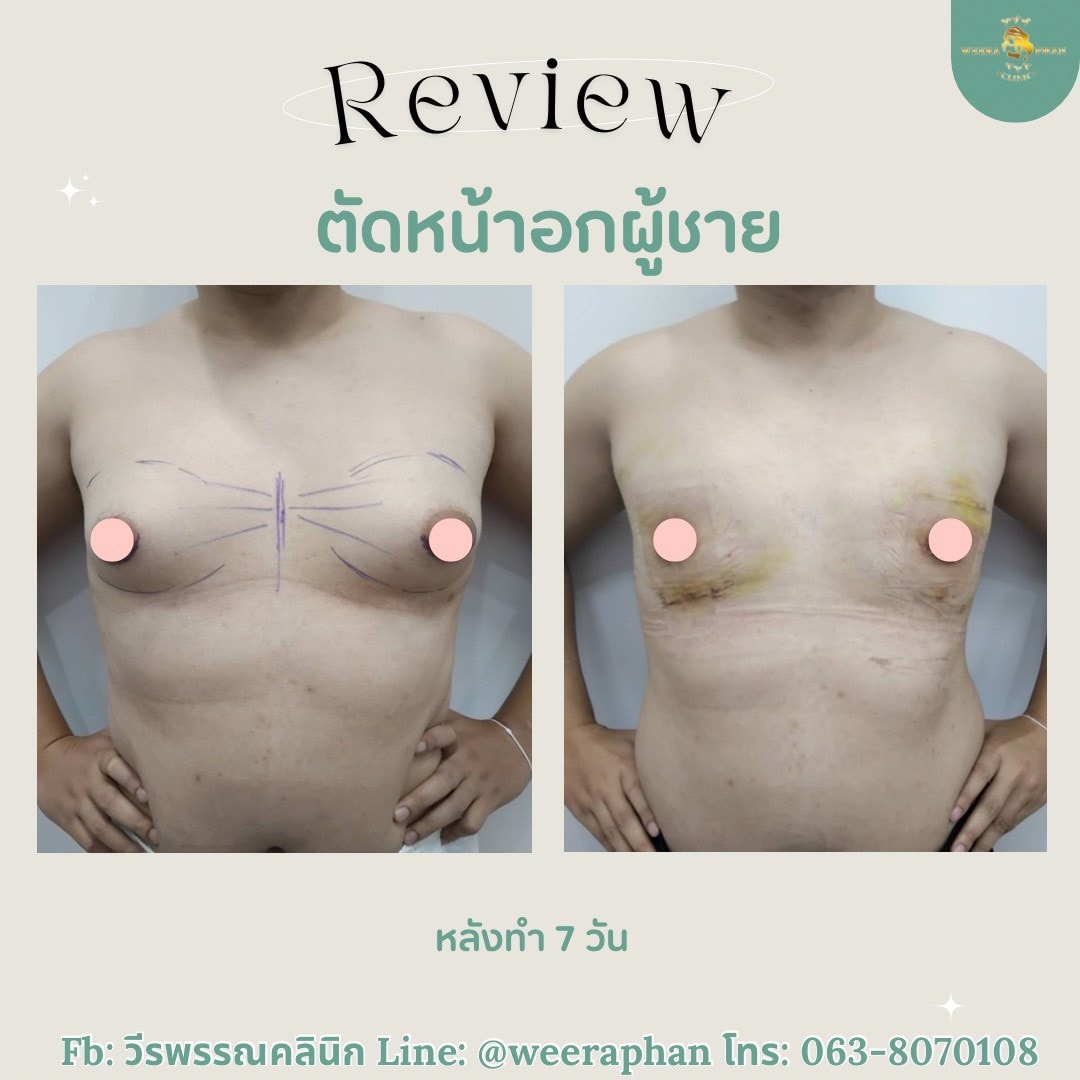 ตัดหน้าอกผู้ชาย