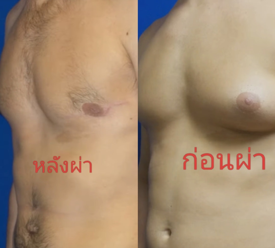 ตัดหน้าอกผู้ชาย
