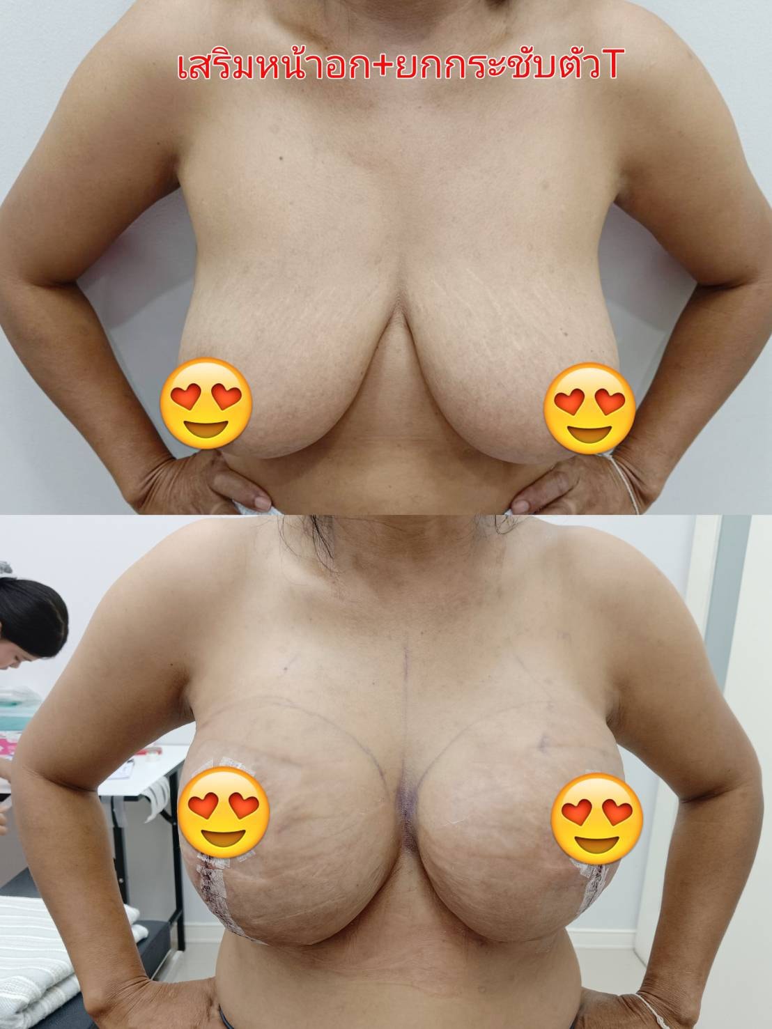 ยกกระชับหน้าอก