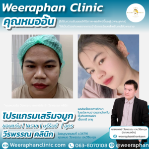 เสริมจมูก