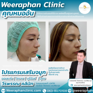 เสริมจมูก