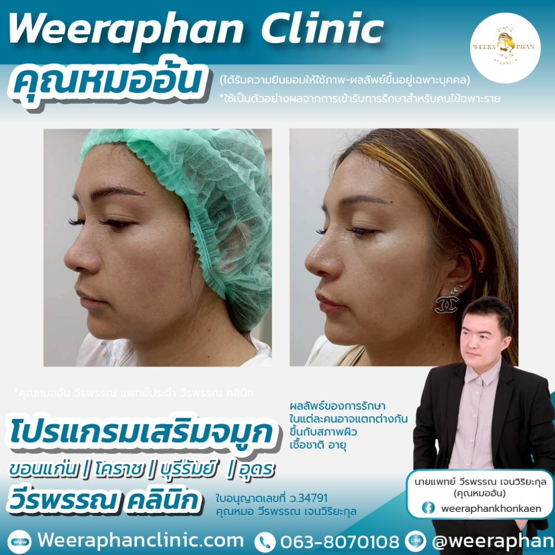 เสริมจมูก