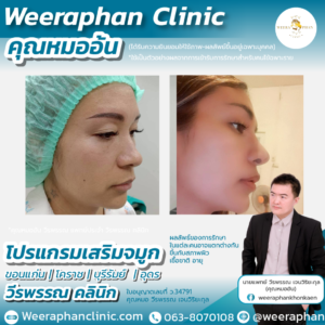 เสริมจมูก