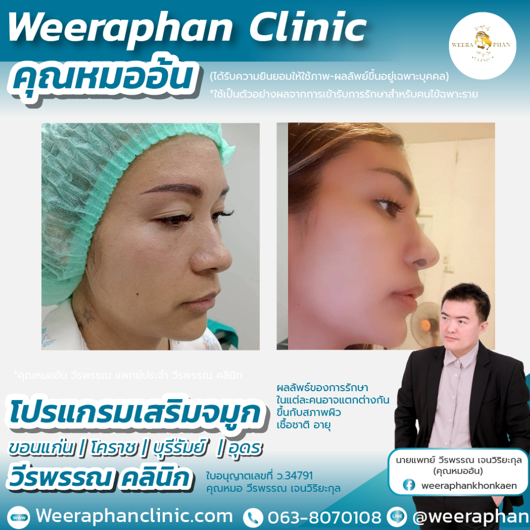 เสริมจมูก