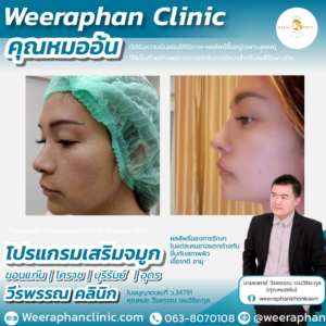 เสริมจมูก