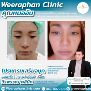 เสริมจมูก