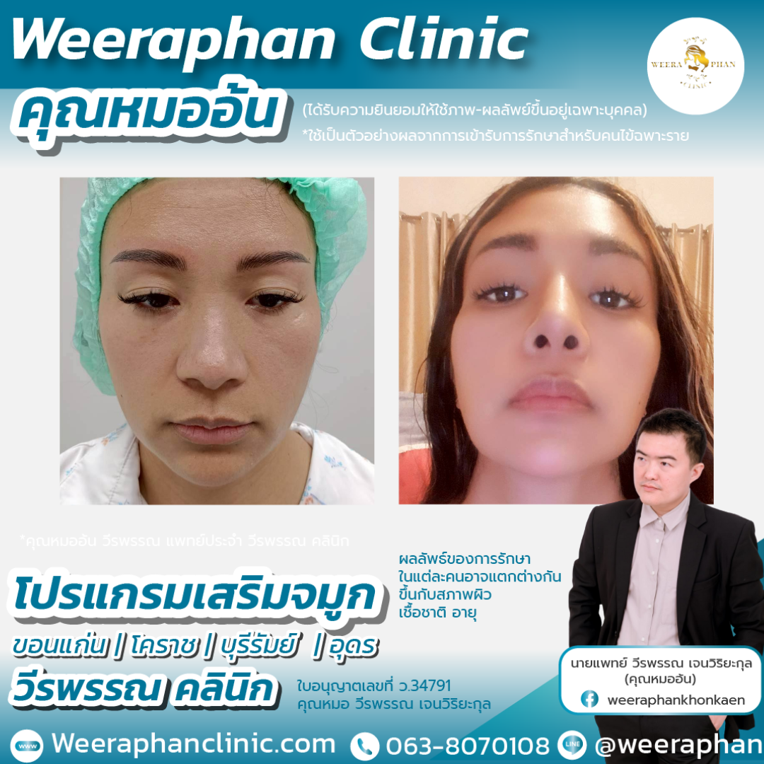 เสริมจมูก