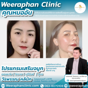 เสริมจมูก