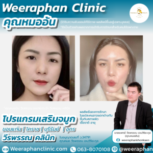 เสริมจมูก