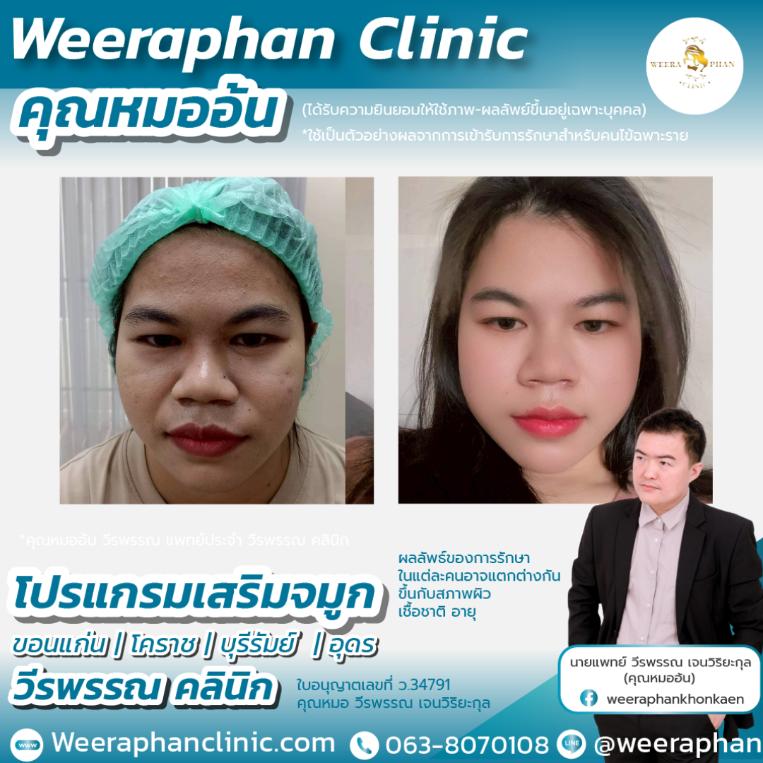 เสริมจมูก