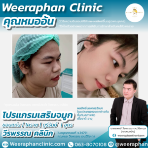 เสริมจมูก