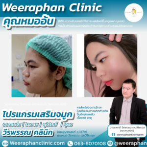 เสริมจมูก