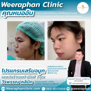 เสริมจมูก