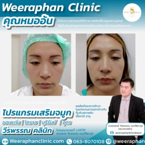 เสริมจมูก