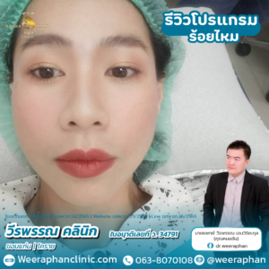 ร้อยไหม