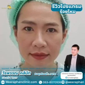 ร้อยไหม ขอนแกน
