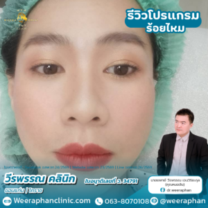 ร้อยไหม