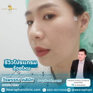 ร้อยไหม