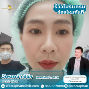 ร้อยไหม