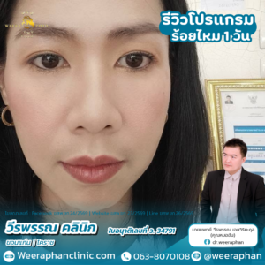 ร้อยไหม