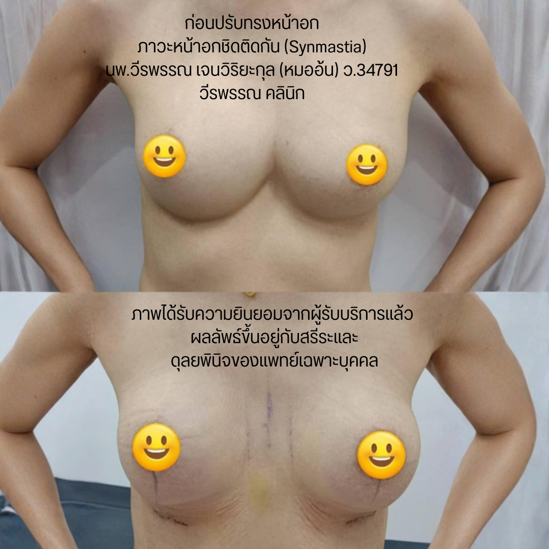 แก้หน้าอก