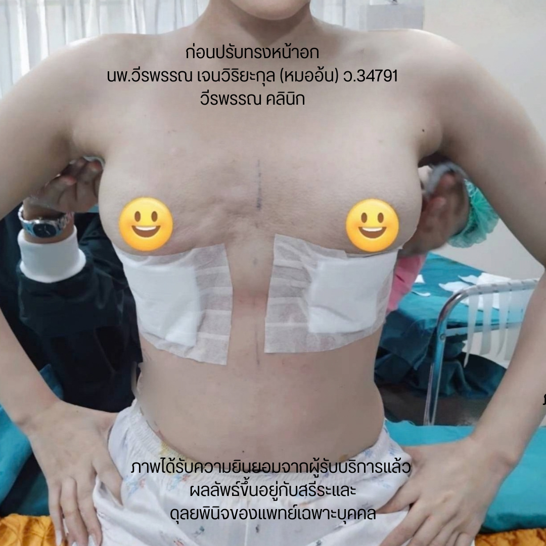 แก้หน้าอก