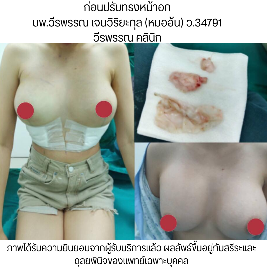 แก้หน้าอก